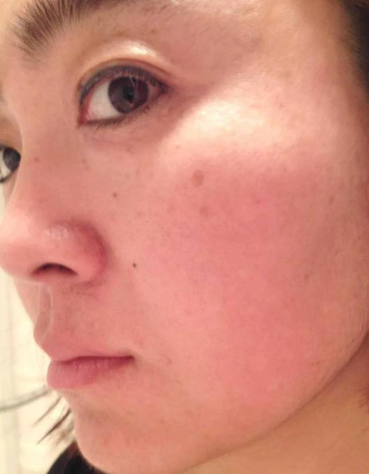 女人脸上有斑点是怎么回事,50岁女人脸上有斑点怎么消除