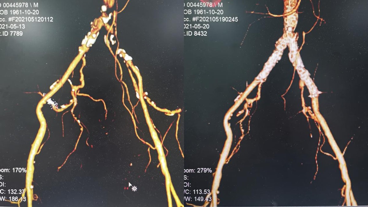 下肢动脉硬化闭塞中医什么科,老人下肢动脉硬化闭塞截肢