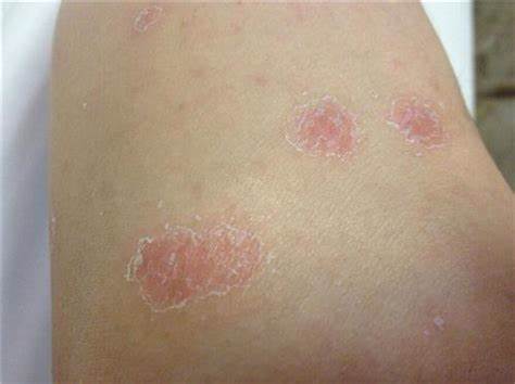 早期强直性脊柱炎会引起结膜炎吗,强直性脊柱炎会在春季得结膜炎吗