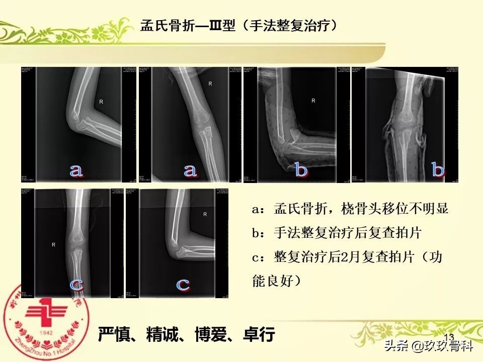 孟氏骨折功能训练多久能恢复正常,孟氏骨折中医能治吗
