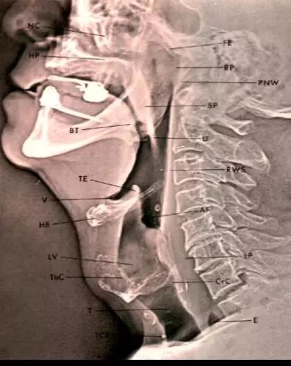 喉部病变做核磁还是ct,耳鼻喉科常见病影像诊断