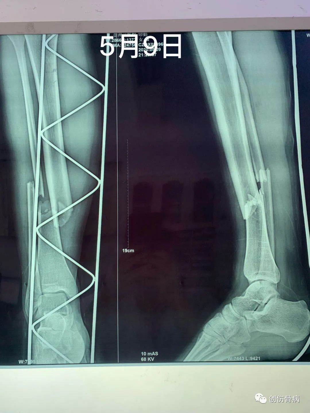 脂肪填充栓塞概率,脂肪填充栓塞几率