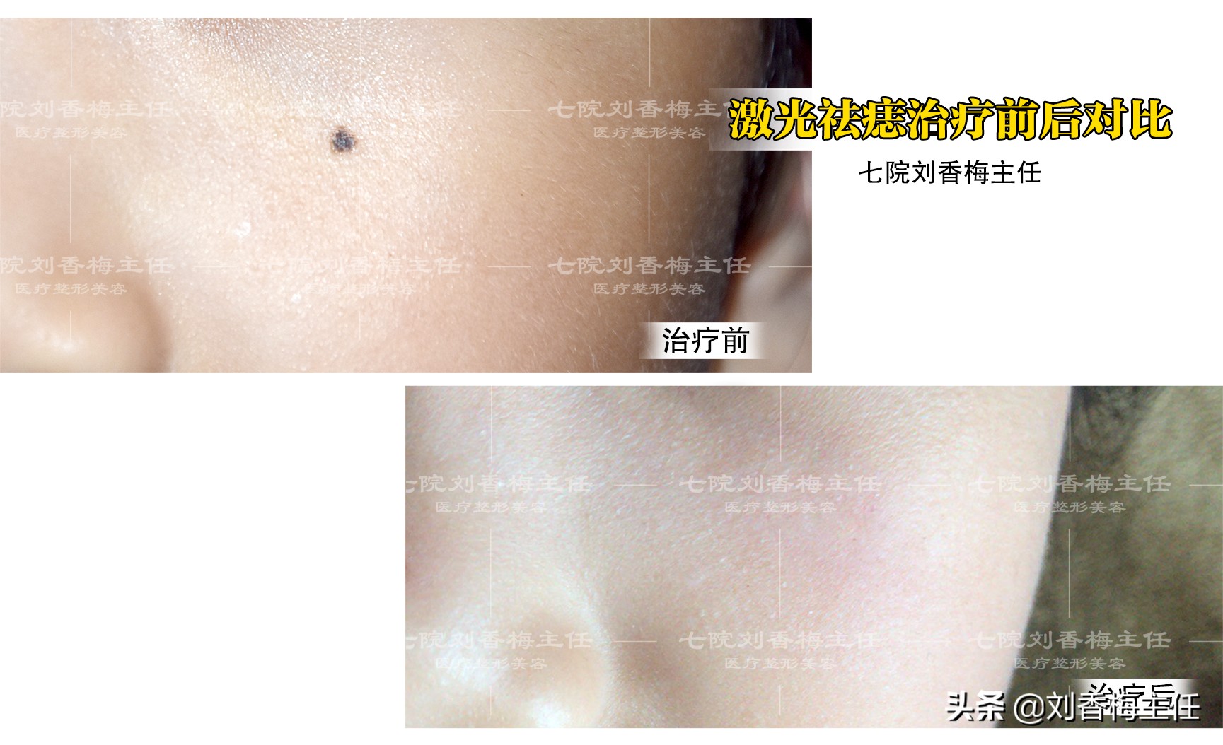 黑痣要不要去除,黑痣切除医生说需要做病理