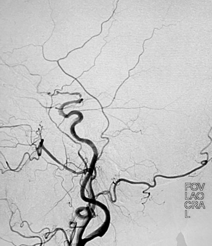 颅内巨大动脉瘤首选治疗技术,大脑中动脉动脉瘤闭塞的介入治疗