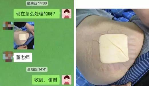 压疮液体敷料怎么用,压疮的治疗首选敷料