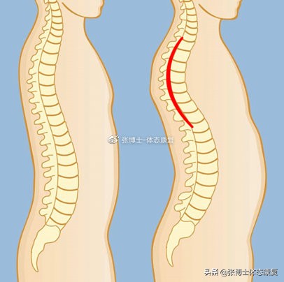 运动腰肌损伤怎么恢复,运动康复腰椎失稳