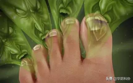 夏季脚气的最佳治疗方法,夏季脚气高发如何才能不受气