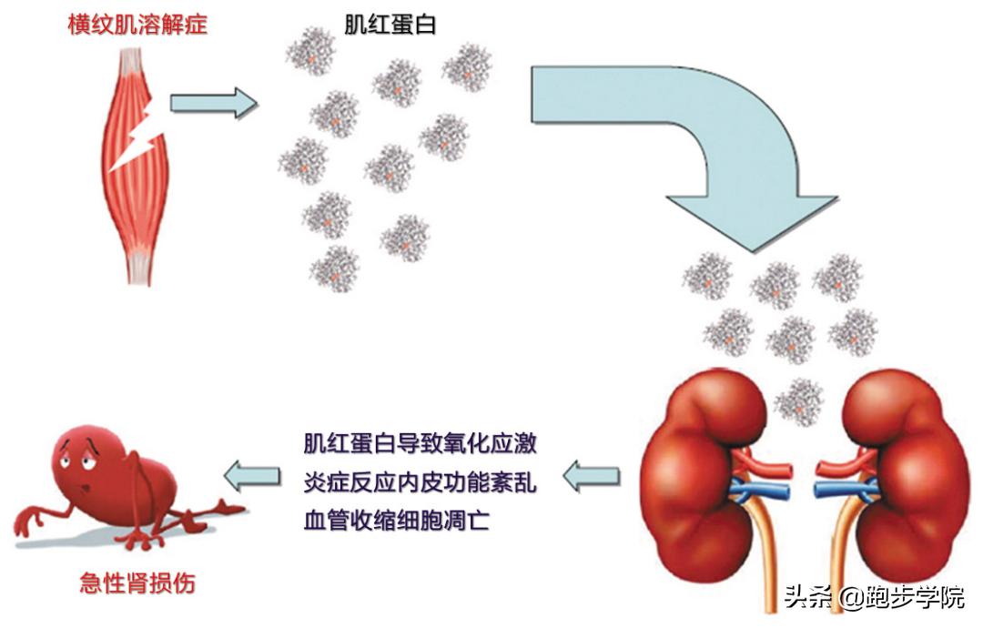 18岁运动时漏尿是怎么回事,运动不当引起茶色尿后自愈