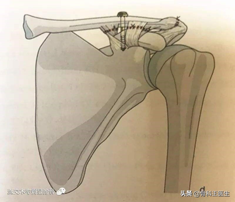 武磊肩锁关节脱位怎么治疗,武磊肩部受伤