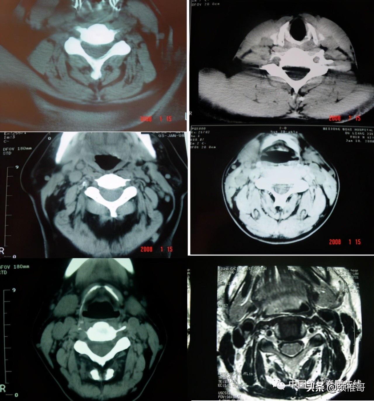 颈椎病的护理临床路径流程图,颈椎病的健康管理与康复指导