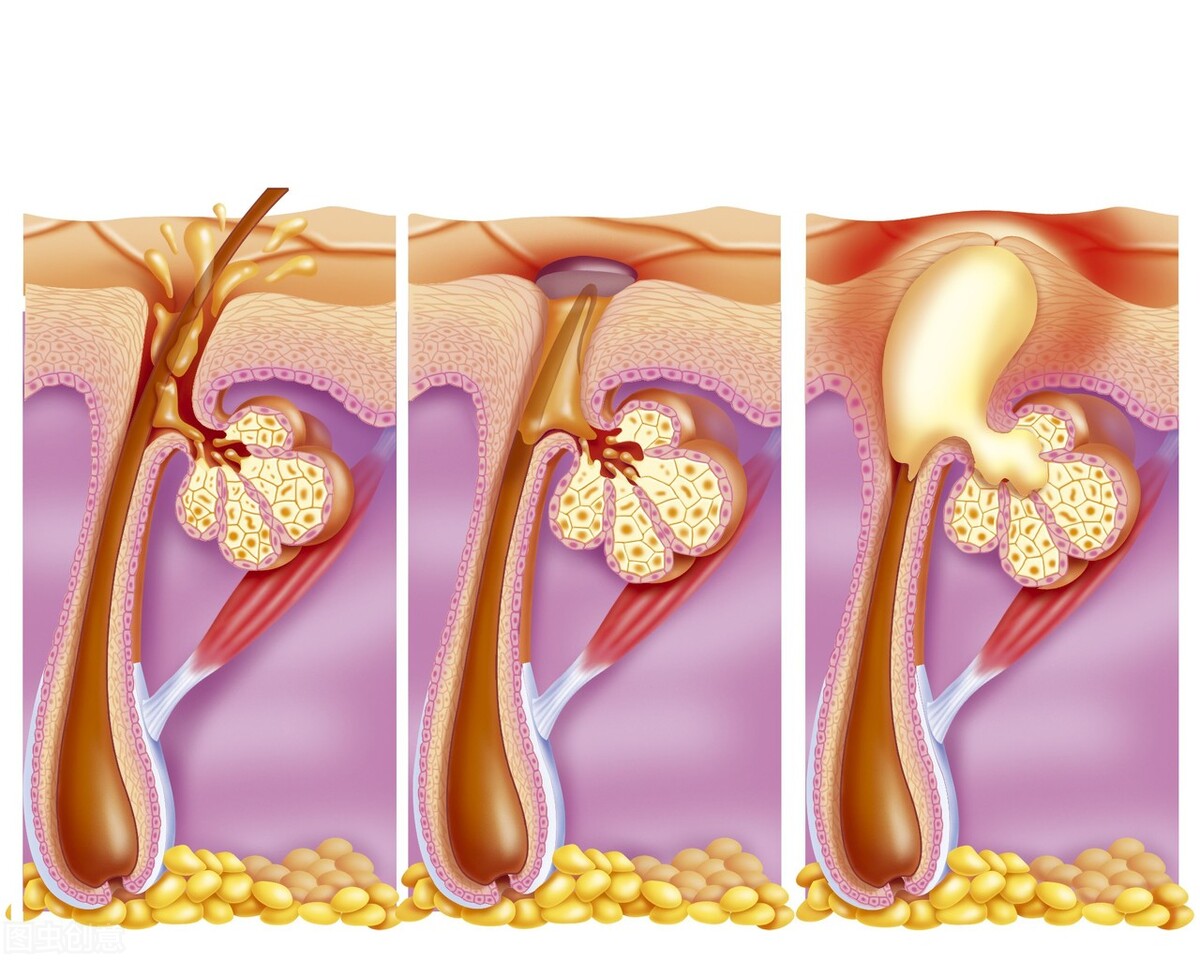 有哪些方法可以清除闭口粉刺,黑头闭口粉刺怎样才能彻底清除