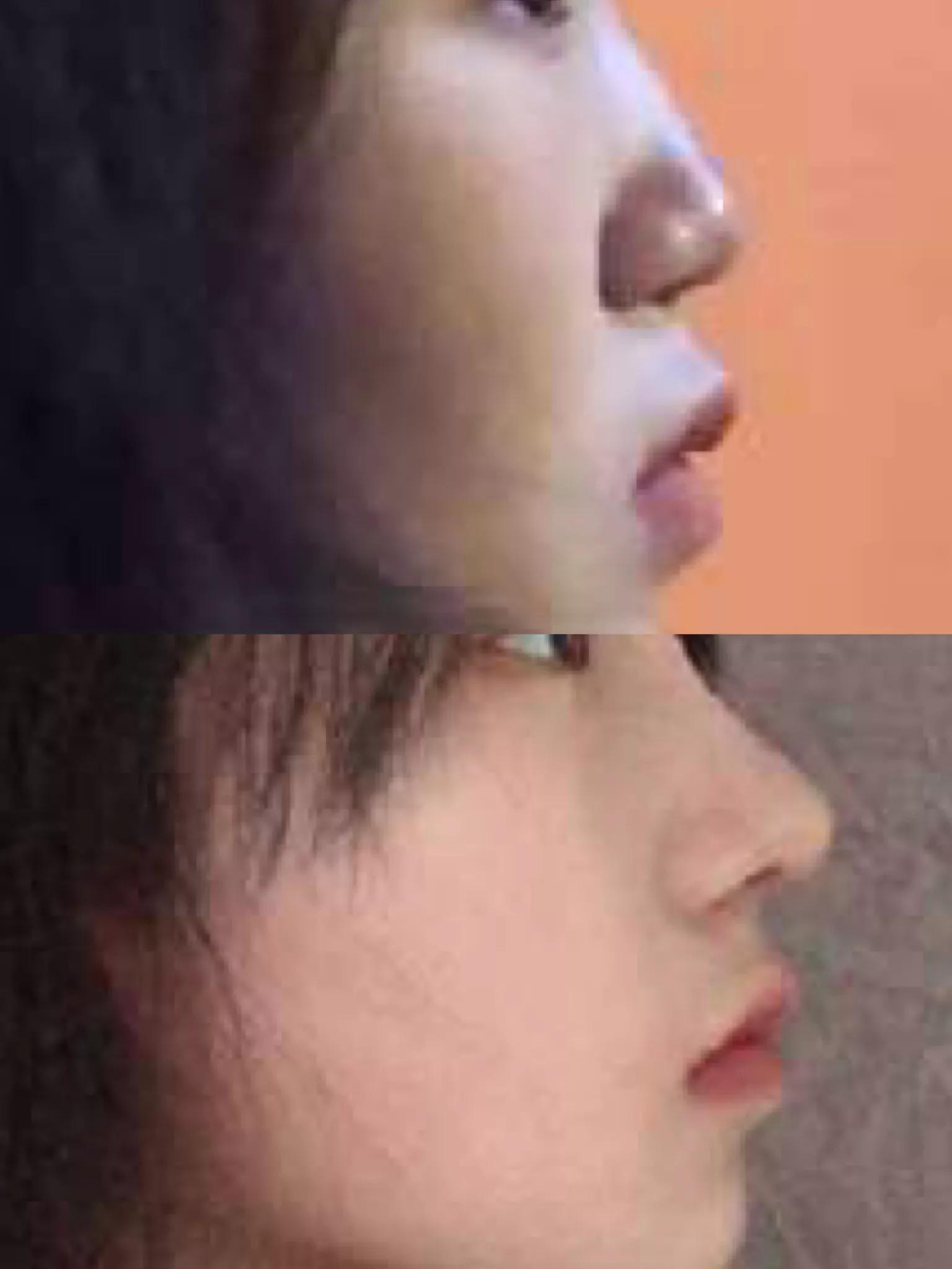 假体隆鼻后5天鼻尖发红,假体隆鼻三年后鼻尖发红