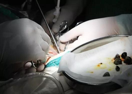 痛风的非药物处方,痛风治疗的最神秘草药