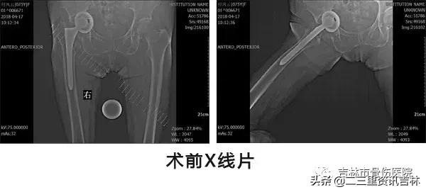 从医30余年，他治疗数以万计骨伤骨病患者
