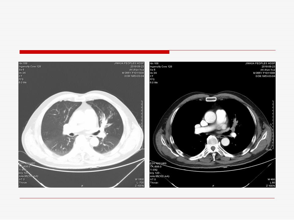像炎症的肺癌能治好吗,医生说可能是肺癌也可能是炎症