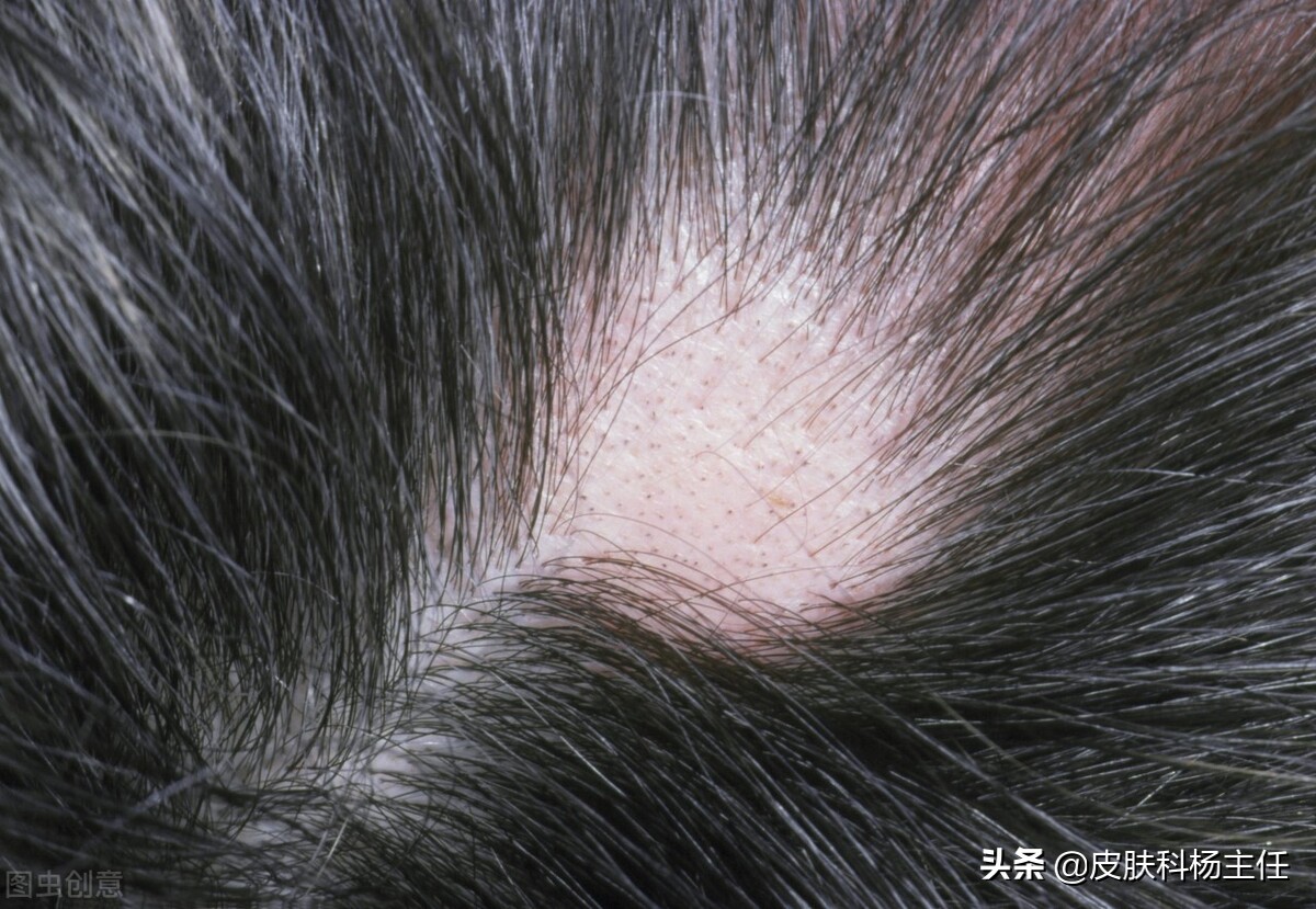 白癜风色素移植会有并发症吗,小朋友得了白癜风有什么并发症