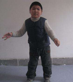 是什么原因会导致脑瘫,脑瘫腿部畸形可以治疗好吗