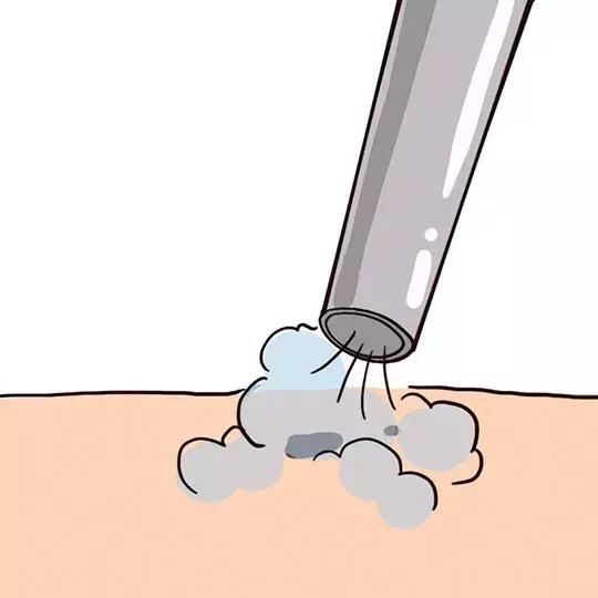 激光祛痣后悔吗,激光祛痣没掉反而更大