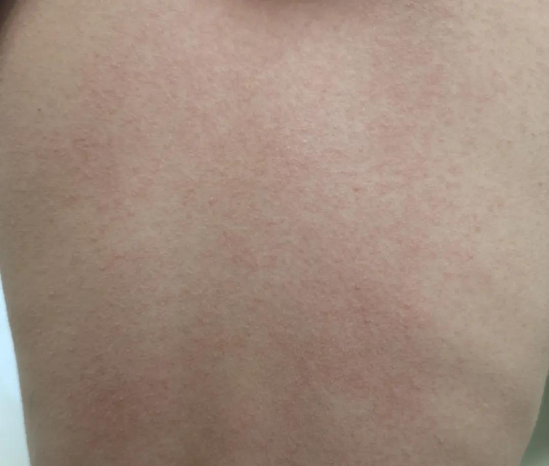 链球菌感染导致皮肤病,革兰氏阳性球菌皮肤病