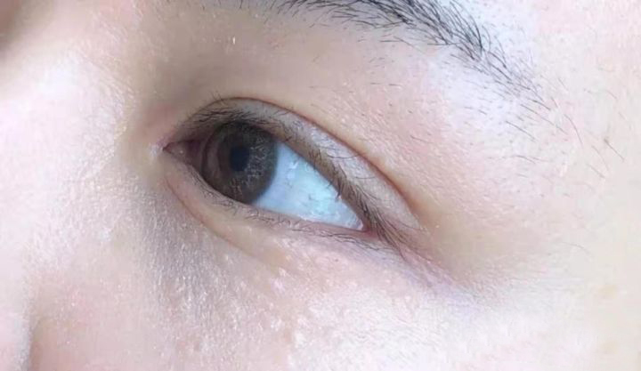 脸上的小疙瘩看得出来吗,脸上的小疙瘩是角质层吗