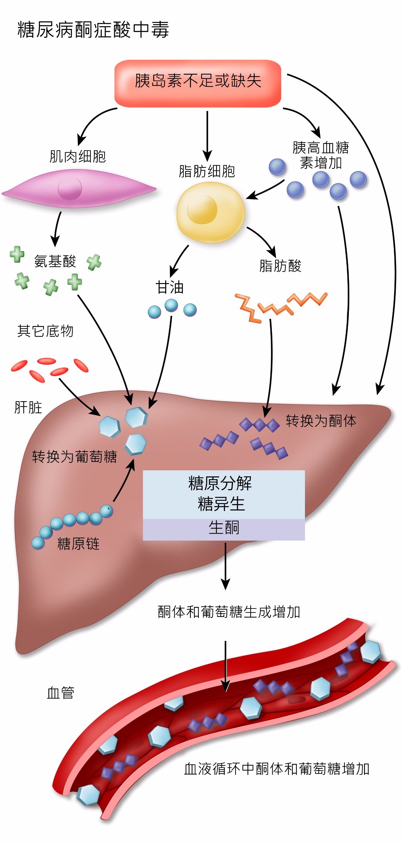 糖尿病并发酮症酸中毒是什么病,1型糖尿病并发症酮症酸中毒