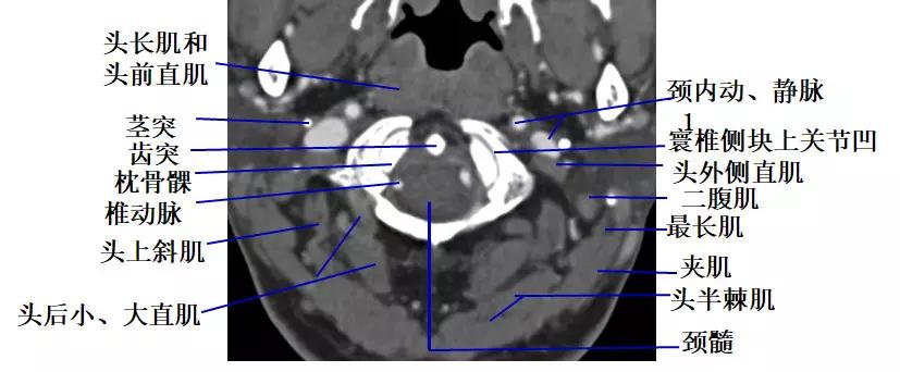 颈椎腰椎疾病ct及mri诊断,腰椎ct可以发现肠部病变吗