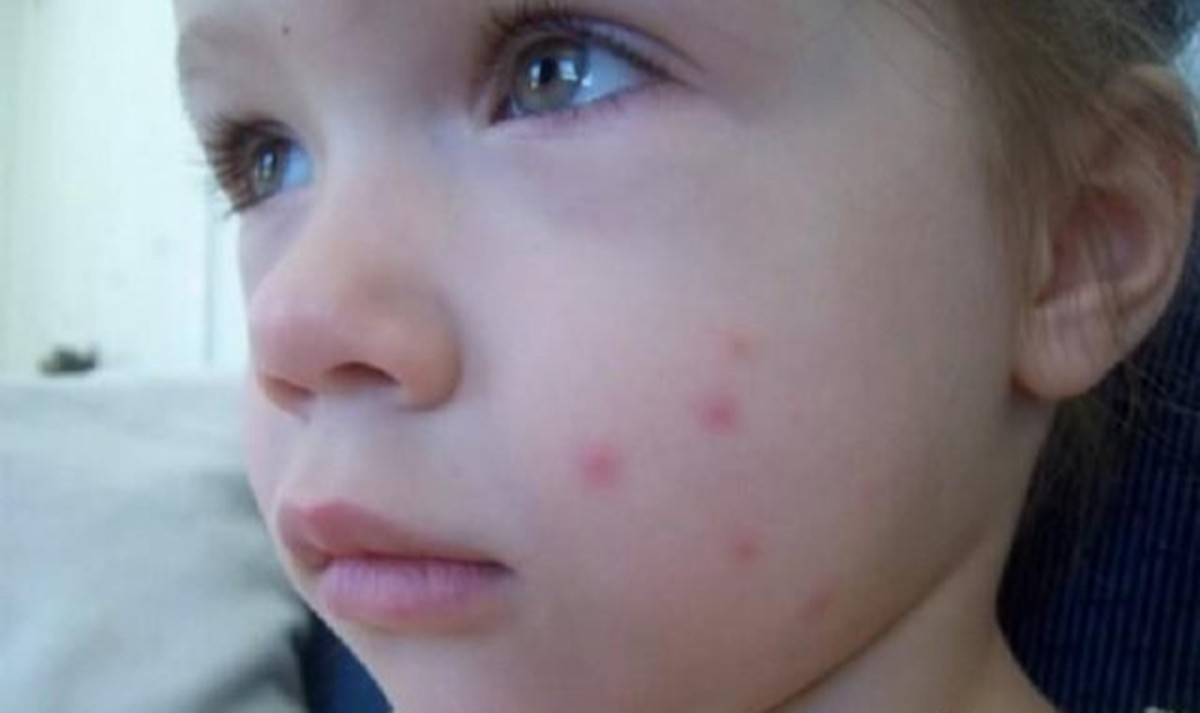 宝宝被蚊子叮咬后多久会好,婴儿经常被蚊子叮咬会有什么影响