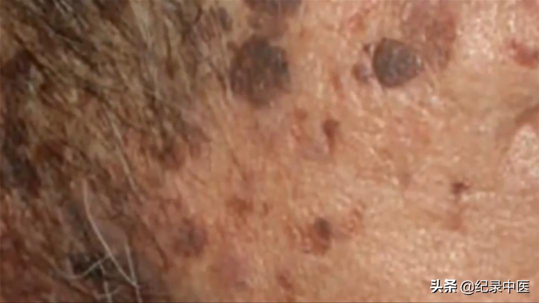 文字版|中医师带瘤生存二十载，如何用中医思维理解癌症？