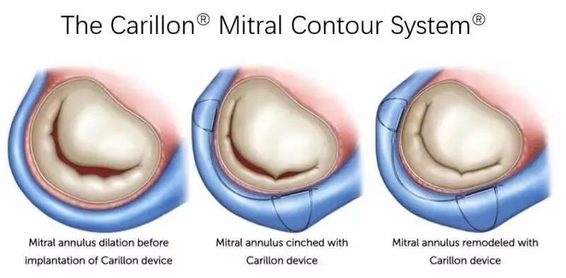 心脏“小门”关不严,经导管二尖瓣介入治疗,不开胸就换瓣