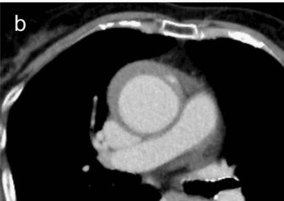 如何监测动脉夹层早期,动脉增强ct能查出主动脉夹层么