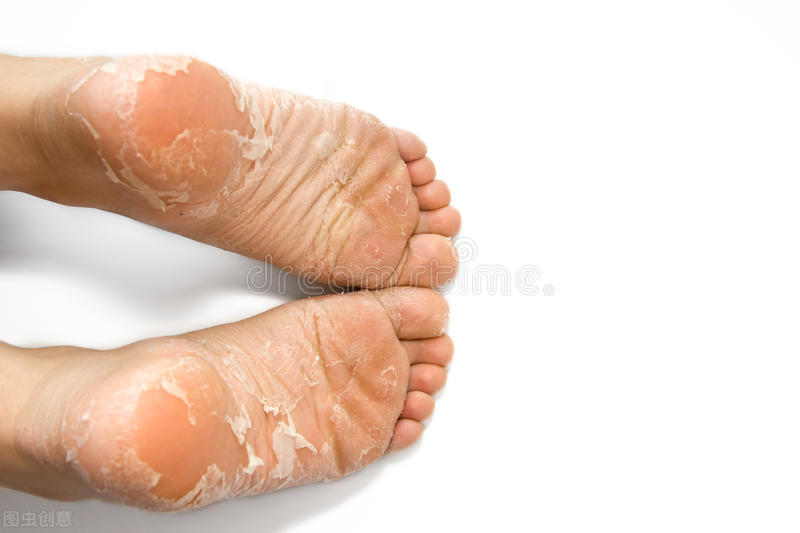 脚气足癣怎么治疗最有效,香港中医治疗脚气的偏方