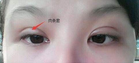 全切双眼皮肉条感重怎么修复,全切双眼皮肉条感怎么缓解