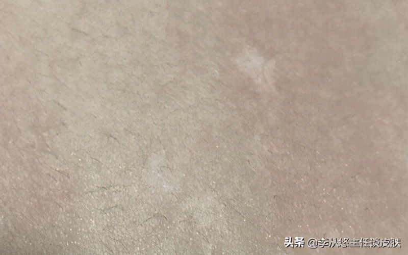 身上有几块白斑能被确诊白癜风,身上白色斑块怎么排除白癜风
