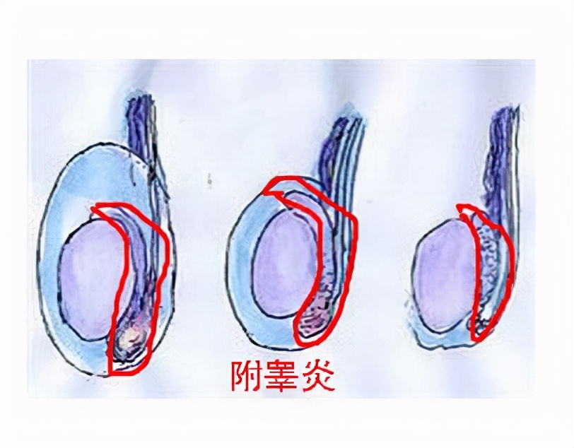睾丸胀疼是什么原因引起的,睾丸胀疼是什么原因