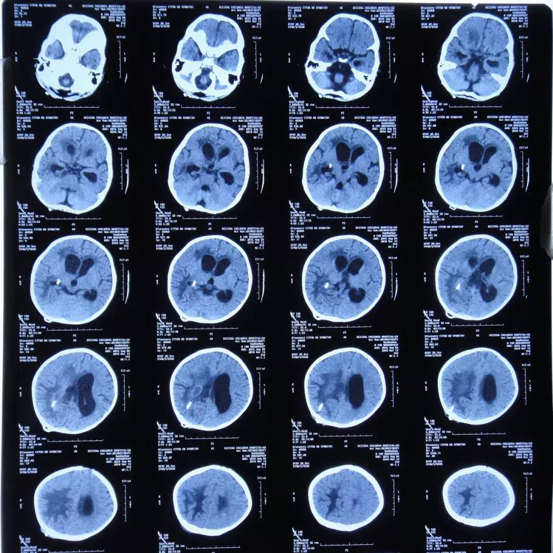 孩子脑积水反复发烧,婴儿脑积水引起发烧如何保守治疗
