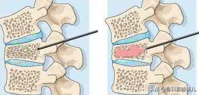 专家建议：老年人出现腰椎骨折，不一定需要做手术！
