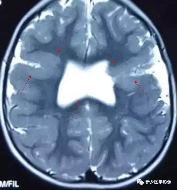 脑室为什么会扩张,脑室为什么会变小