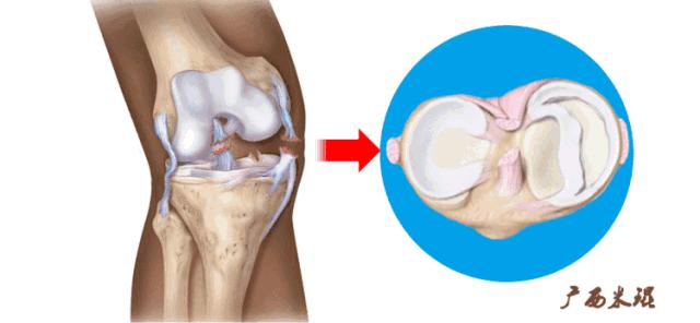 有关半月板的疾病与治疗,听骨科医生讲的话