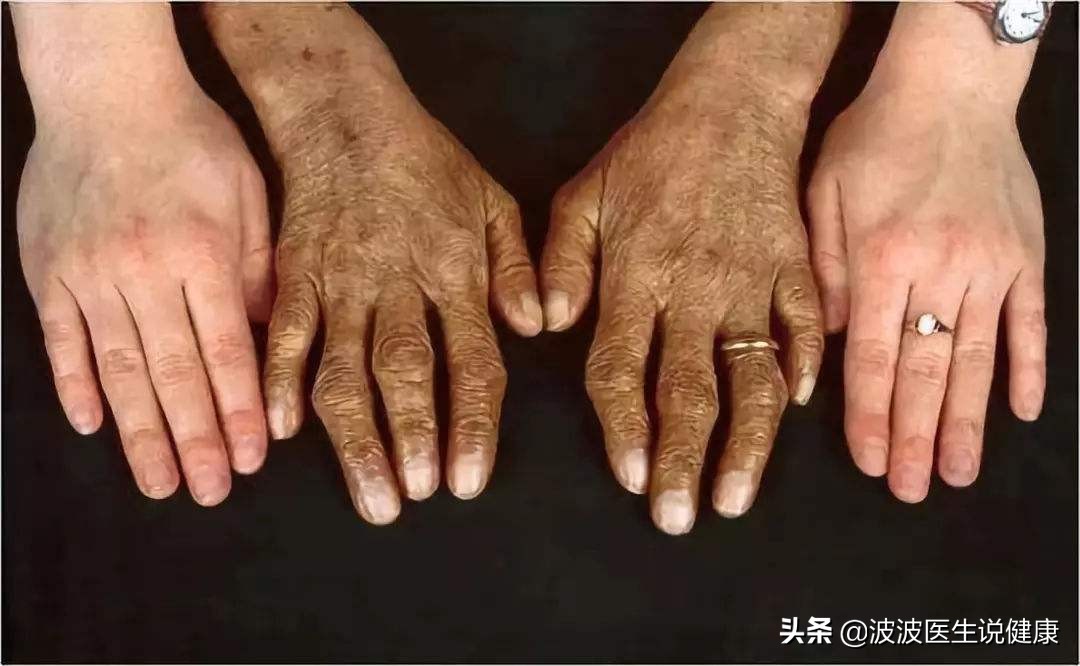 肝硬化肝癌诊治病例分享,2023年肝病防治指南