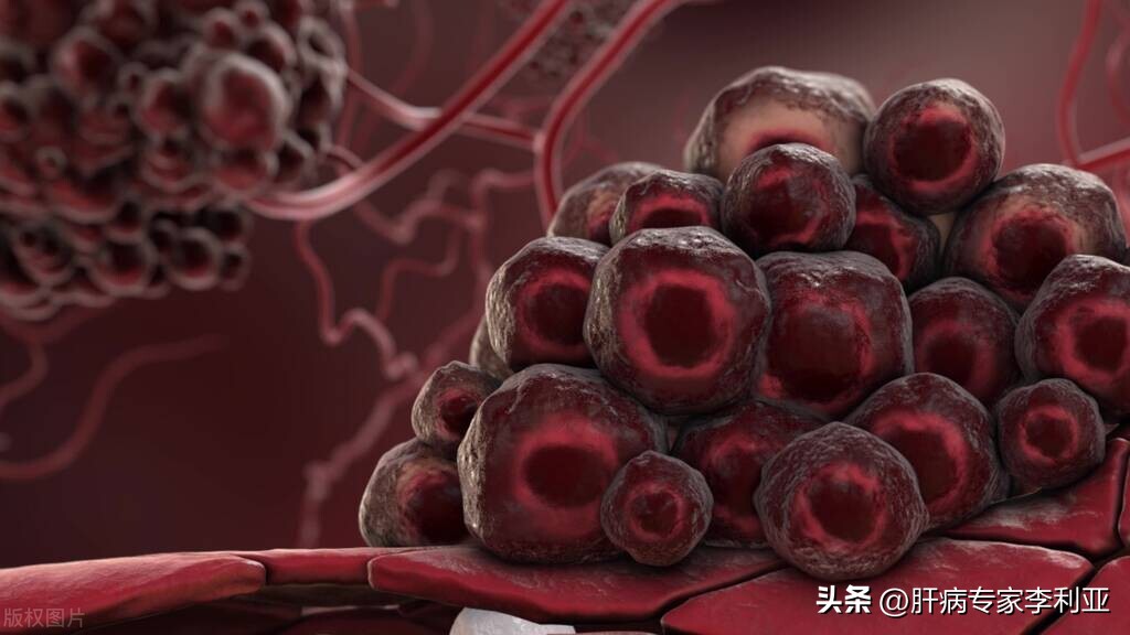 肝癌征兆身上长痘吗,肝癌脸上长痘痘怎么回事