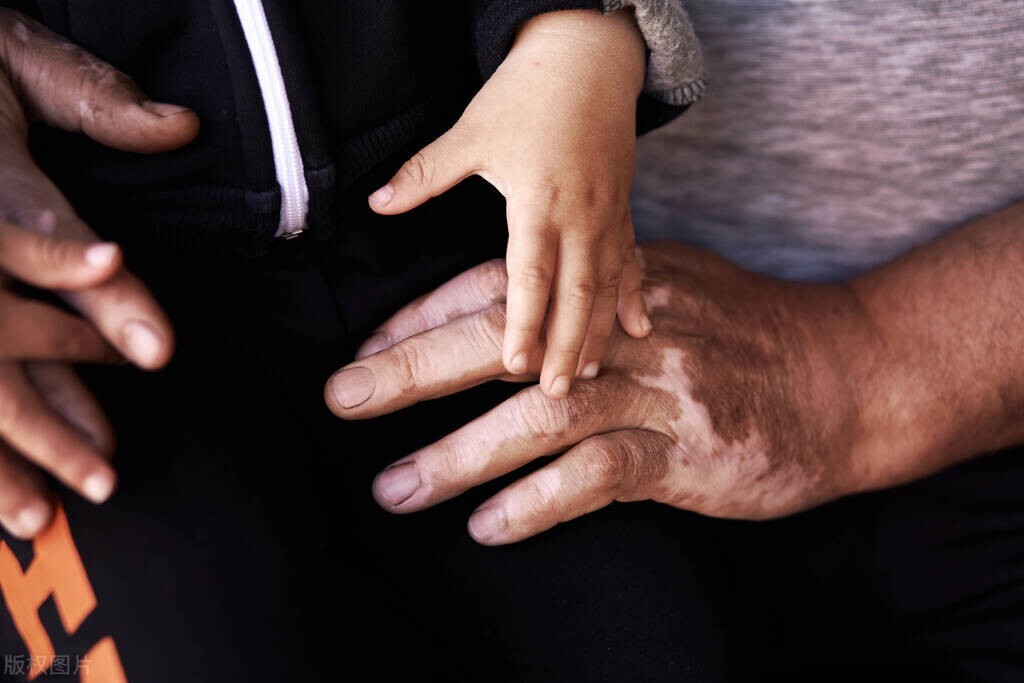 孩子身上出现白斑,新生儿身上有白斑