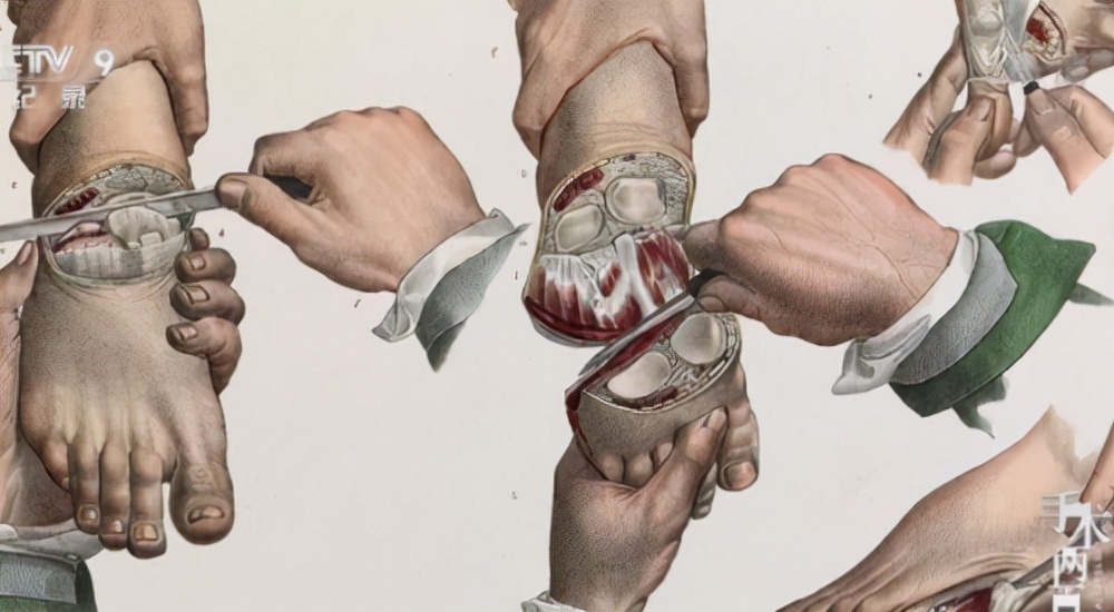 给脑壳钻孔、用吸血虫治病，这些古代治疗手段吓到我了