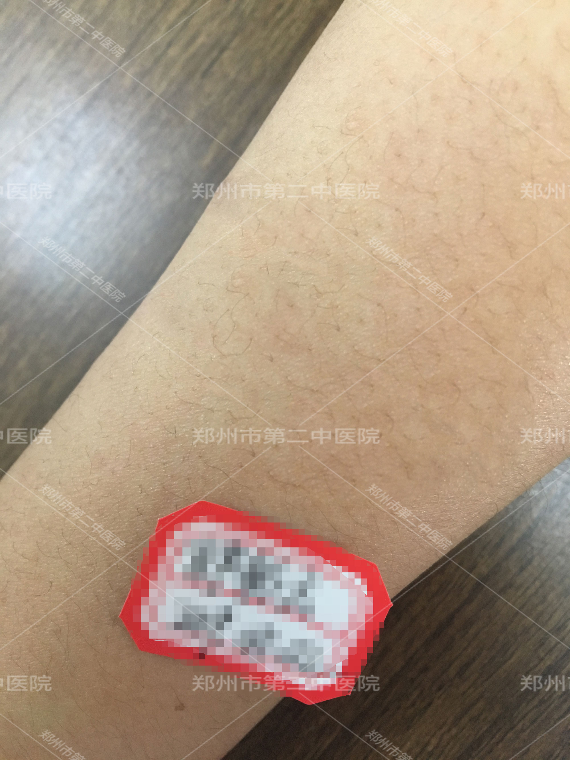 郑州市第二中医院疤痕治疗怎么样,郑州市第二中医院治疗疤痕靠谱吗