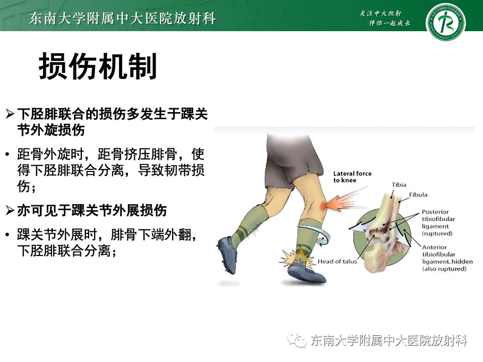左腓骨下段骨折伴下胫腓联合分离,好文分享深度揭秘