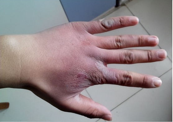 冻伤疤痕怎么治疗效果最好,冻伤疤痕40多年能恢复吗