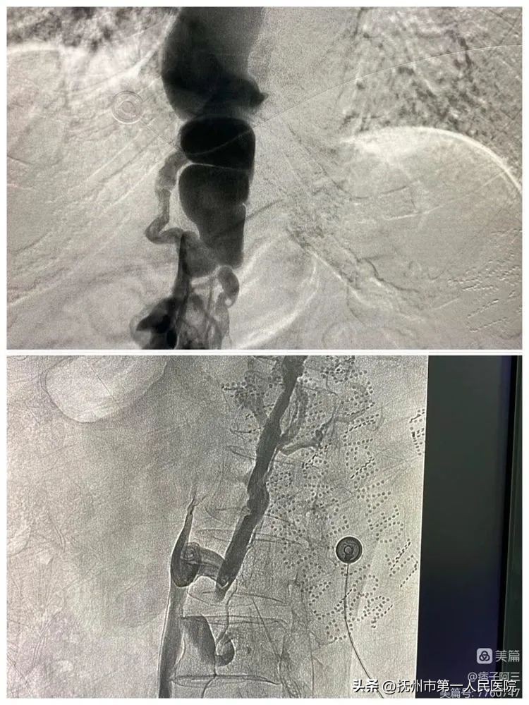 布加氏综合征介入治疗的注意事项,布加综合征介入手术加支架的利弊