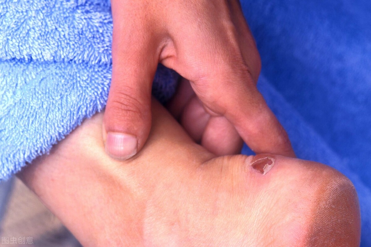 跑步磨脚起茧怎么办,跑步磨脚