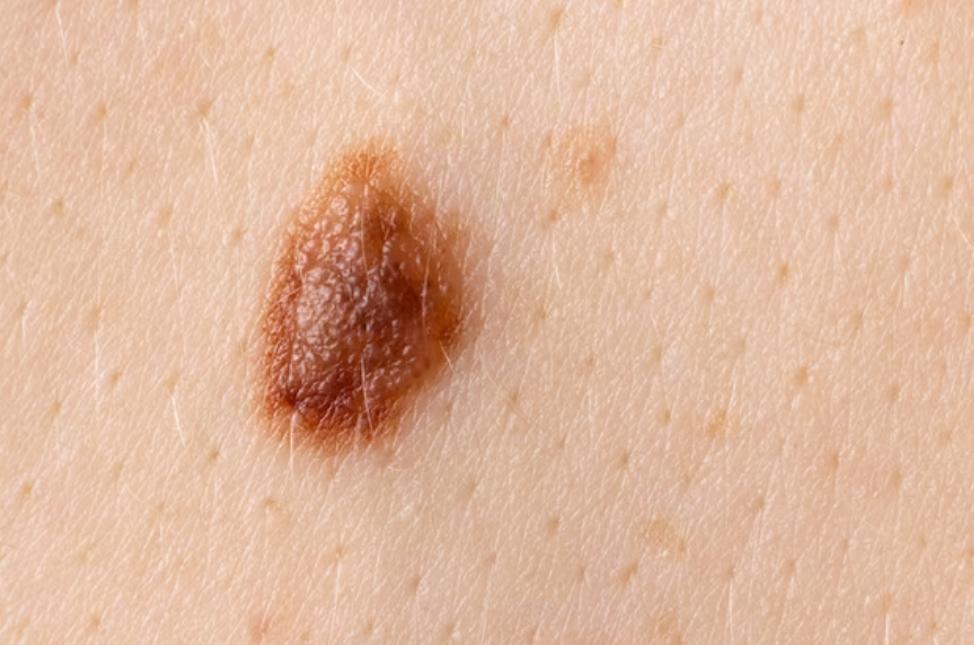 年轻生命的陨落：黑痣与黑色素瘤，你需要知道的区别