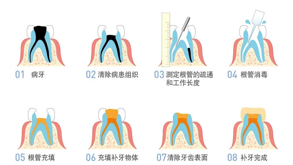 蛀牙到什么程度必须拔掉,蛀牙碰到神经了一定要做根管吗