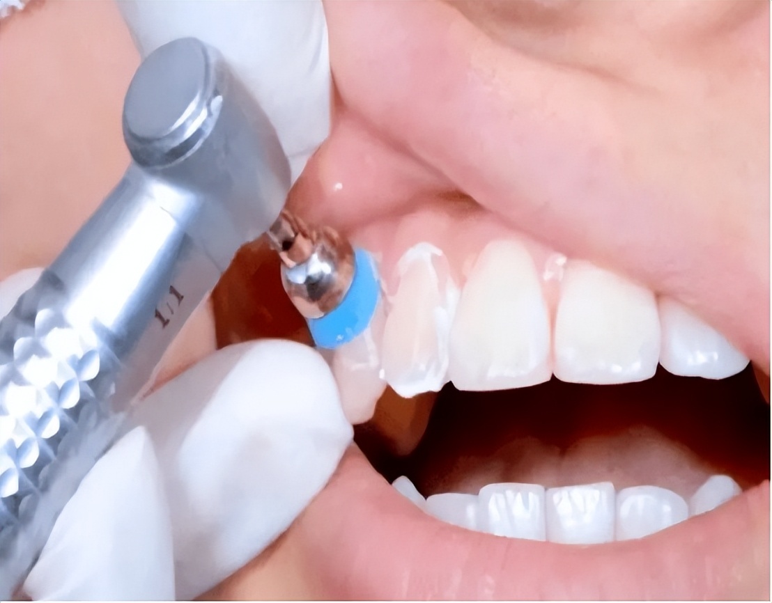 牙齿表面软软发臭的“黄泥”到底是什么?教你三招,轻松去除